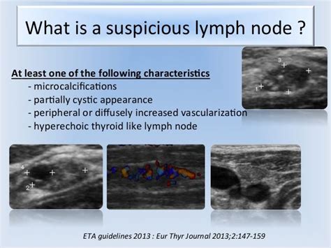 During the study period, we considered a lymph node to be suspicious when it had one of following features loss of fatty hilum, cystic change, calcification, hyperechogenicity (higher echogenicity than the surrounding muscles), and round shape (long to transverse diameter ratio < 1. . Loss of fatty hilum in lymph node meaning